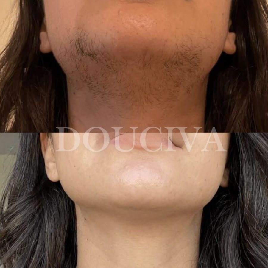 Douciva Huile Botanique Anti-Repousse | Alternative Naturelle au Laser